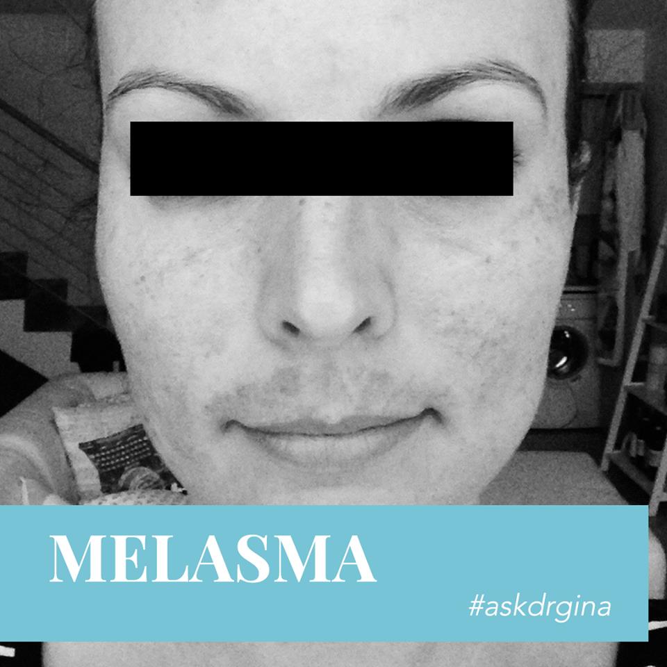 #AskDrGina – Melasma