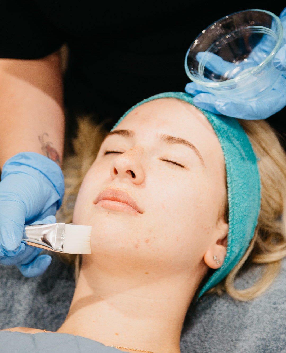 Acid Talk – What is a Chemical Peel for?