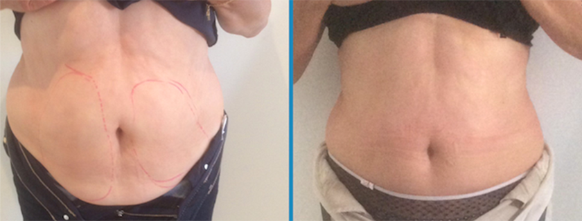 Body Contouring with Cristal at Ocean Cosmetics