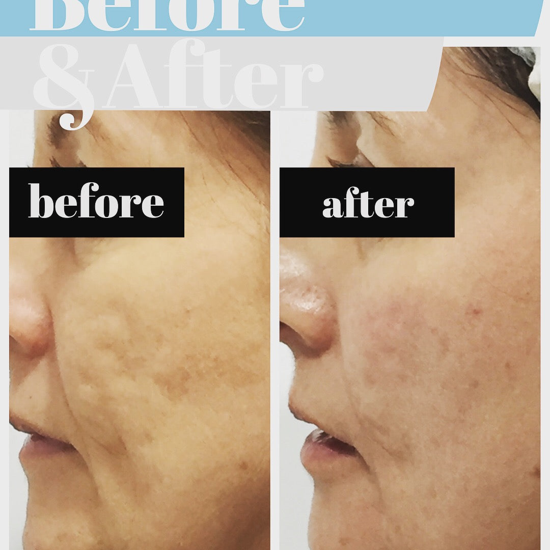 Dermal Skin Remodelling at Ocean Cosmetics