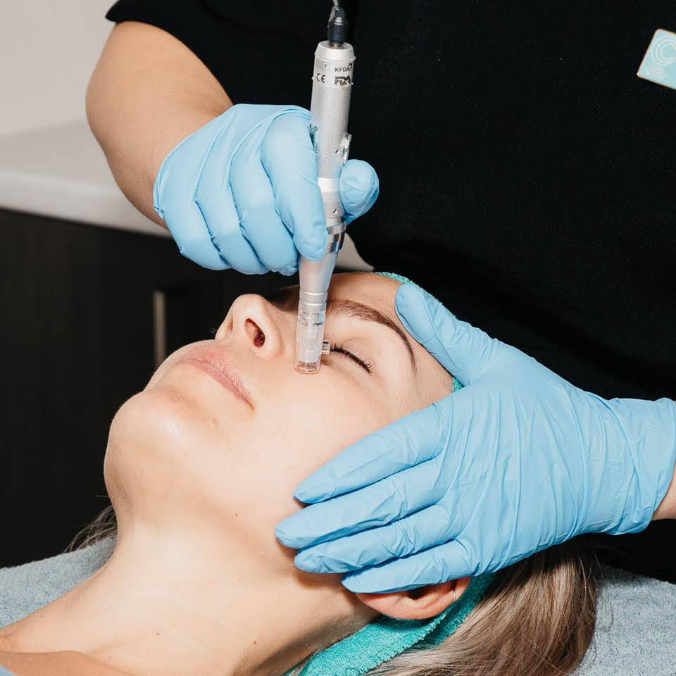 Micro Skin Needling Treatment – Full Facial Treatment