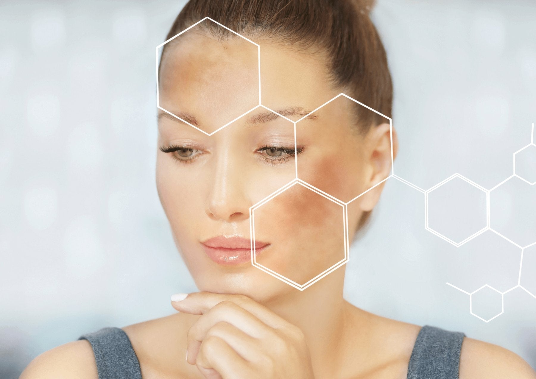 Managing Melasma