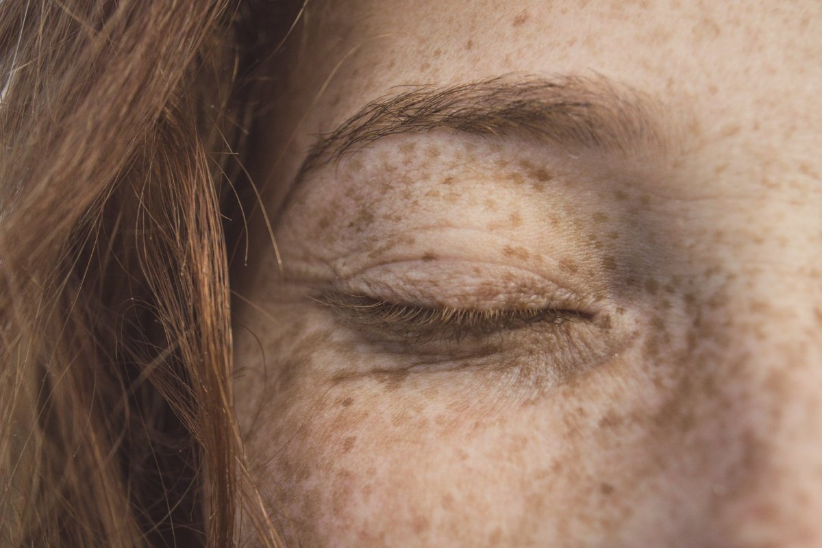 Hyperpigmentation – What is it and Why do we have it?