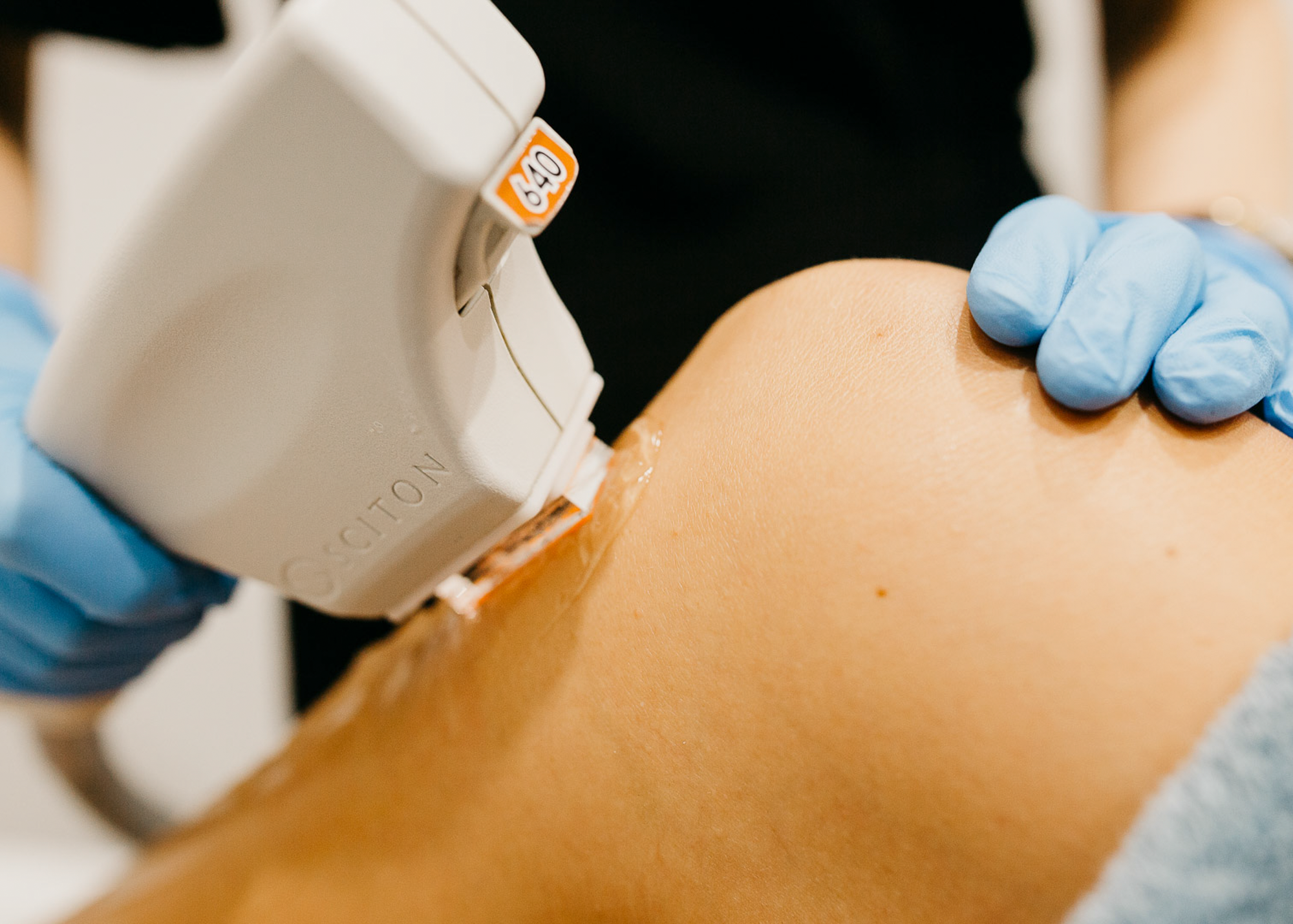 Laser Hair Removal vs IPL