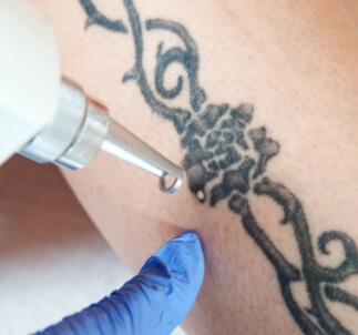 Laser tattoo removal at Ocean Cosmetics 04