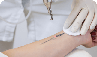 tattoo removal grid Treatments - 9