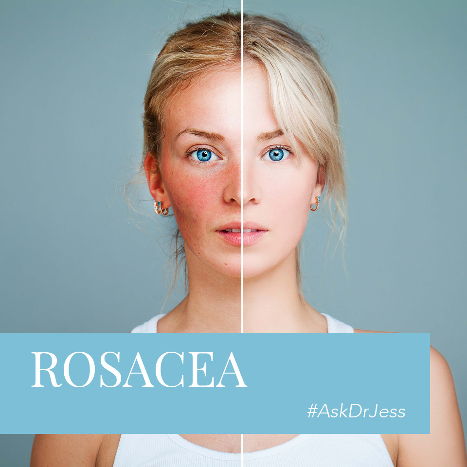 Rosacea covr photo #AskDrJess - Rosacea - 2