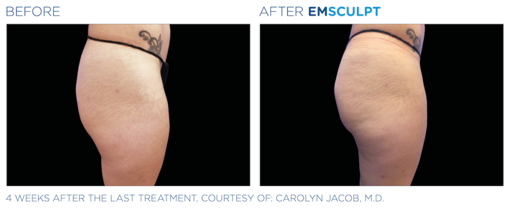 Emsculpt neo | Ocean Cosmetics | Before and After | Perth