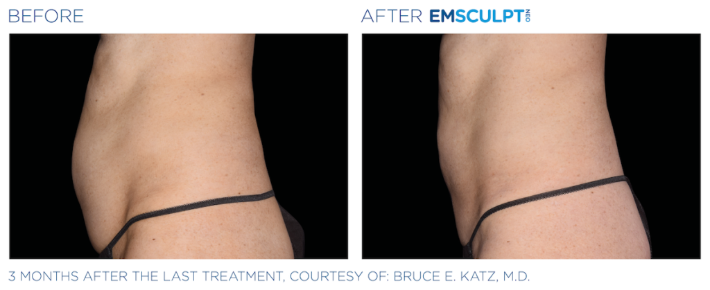 Emsculpt neo | Ocean Cosmetics | Before and After | Perth