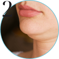 Double Chin Treatment img 30s - 3